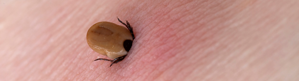 a tick biting through human flesh